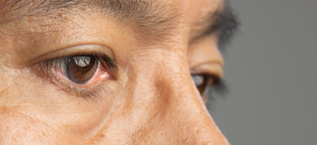 Close up of a man's eyes, looking for potential complications from diabetes