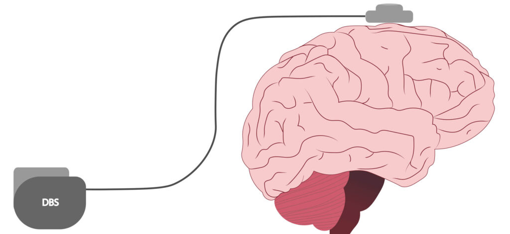 Deep brain stimulation for multiple sclerosis