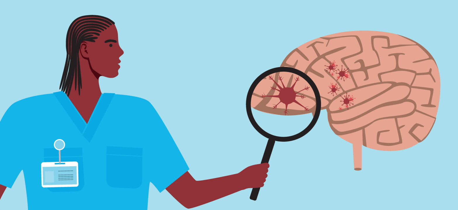 A doctor examining a brain under a magnifying glass, learning how MS flares affect work